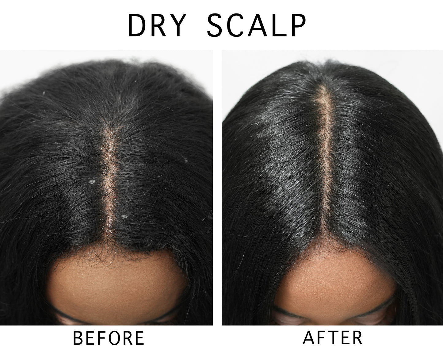 ScalpFacial™ for Dry Scalp & Scalp Massage Brush Kit